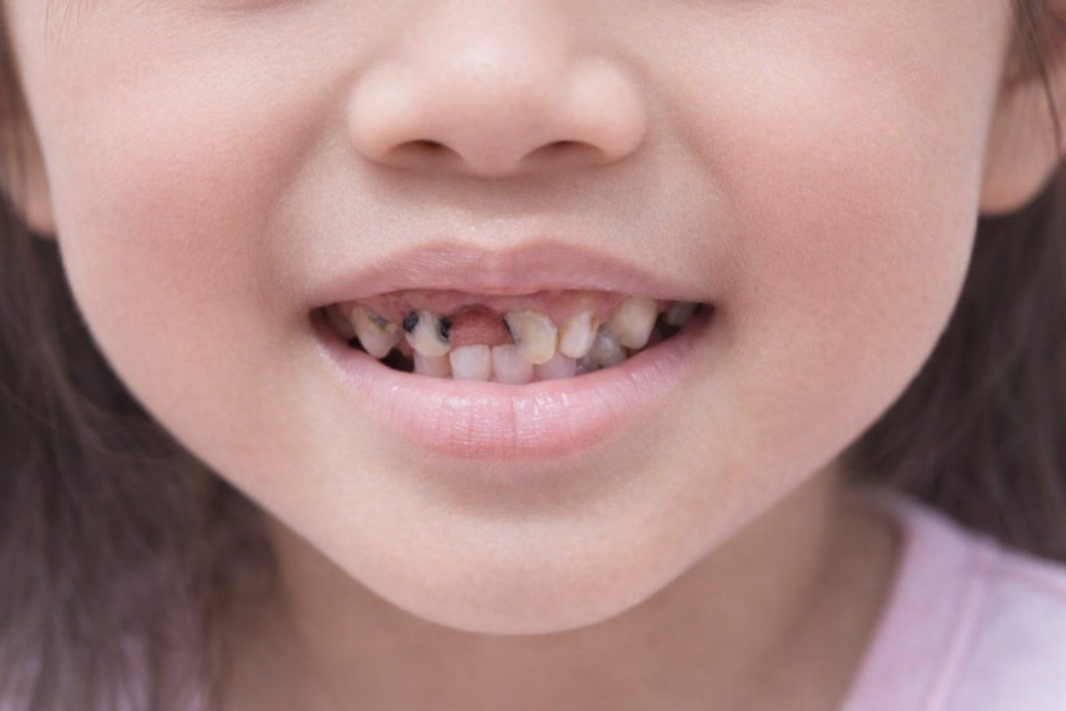 Teeth before dental treatment at Hariharan Dental Clinic